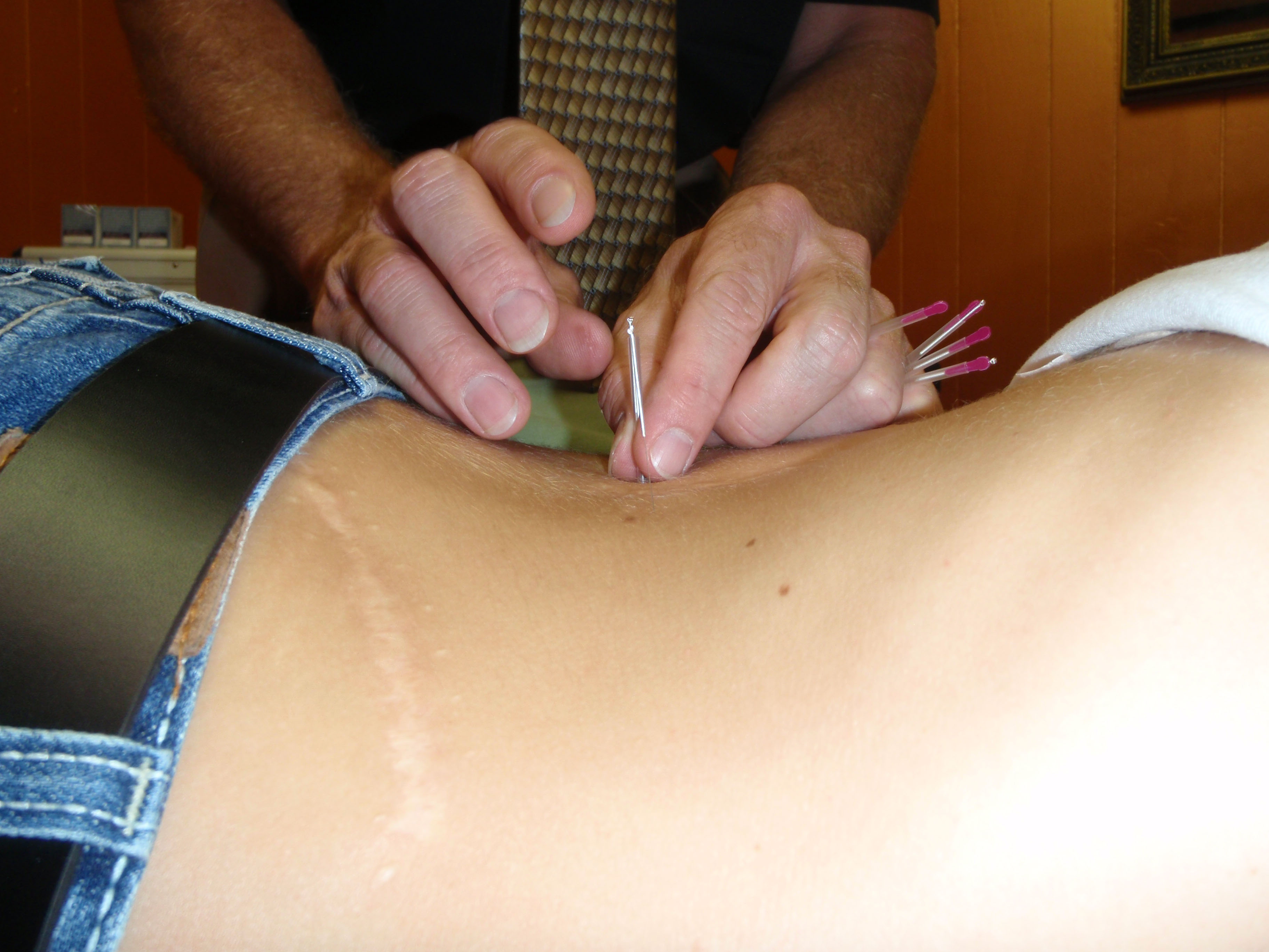 Acupuncture with Marc Herns