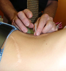 Acupuncture - Marc Herns